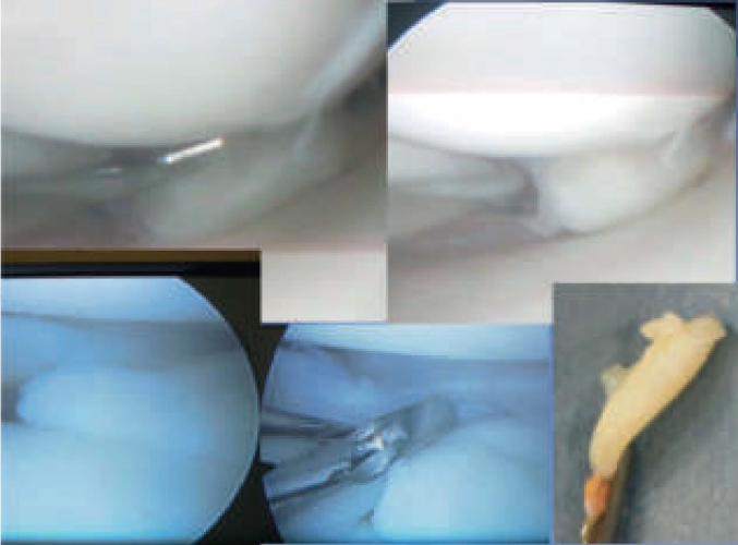 lesioni-meniscali-magnani